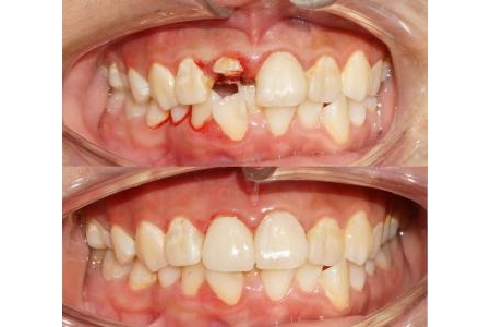 Phục hình răng thẩm mỹ cho răng cửa trẻ em