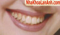 truoc khi lam trang rang