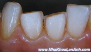 rang moc vao trong chua dap su veneer