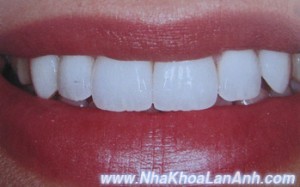 Ket qua dap veneer su