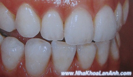 Rang da duoc dap veneer, lam rang su o dau tot