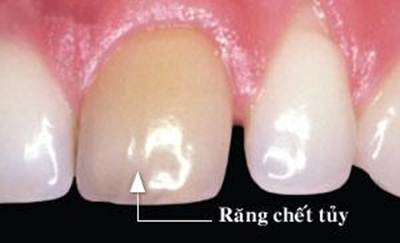 rang-cua-chet-tuy-bi-doi-mau