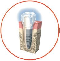 hinh-anh-bang-gia-implant