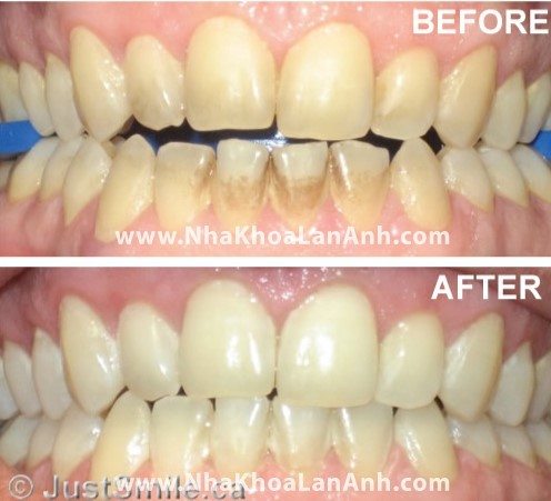 Chú thích: Răng bị nhiễm màu do thuốc lá, cà phê được tẩy trắng cho kết quả rất tốt.