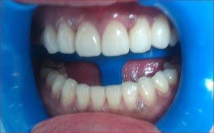 sau khi phau thuat nuou va phuc hinh rang su tham my bang veneer su 6 rang cua ham tren