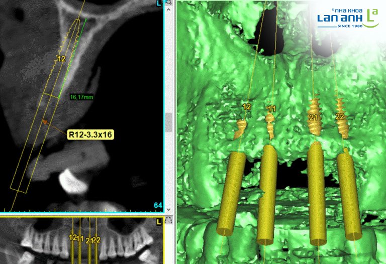 phim ct cone beam cho thay be rong cua xuong co dat implant duoc khong