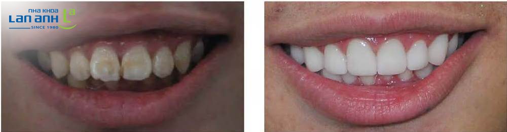 rang sam mau sau khi dieu tri