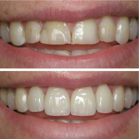 lam rang su cerec cho cac rang cua