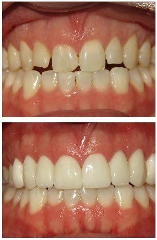 lam rang su cerec tham my