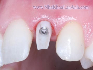 Implant trong trường hợp mất một răng