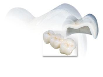 Mão răng là gì? Cầu răng là gì?