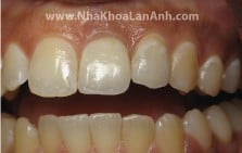 Những câu hỏi thường gặp khi cấy ghép Implant (phần 1)