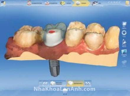 Những câu hỏi thường gặp khi cấy ghép Implant tại nha khoa Lan Anh (phần 2)