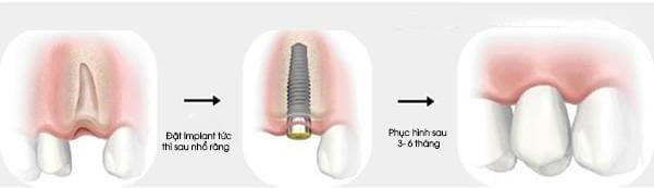 Thời điểm thích hợp cấy ghép implant