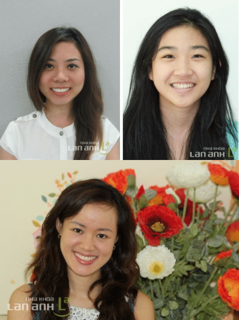 Nhổ răng hạn chế chấn thương trong chỉnh nha