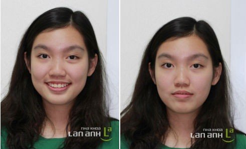 Hình ảnh và kết quả điều trị của một số bệnh nhân đã chỉnh nha tại nha khoa Lan Anh (phần 2)
