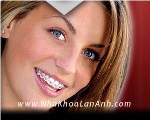 Chỉnh nha (niềng răng) cho người trưởng thành