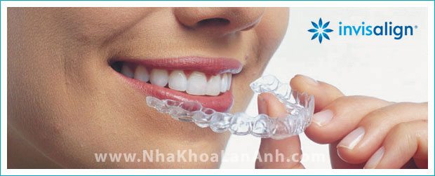 Những câu hỏi thường gặp về Invisalign (phần 2)