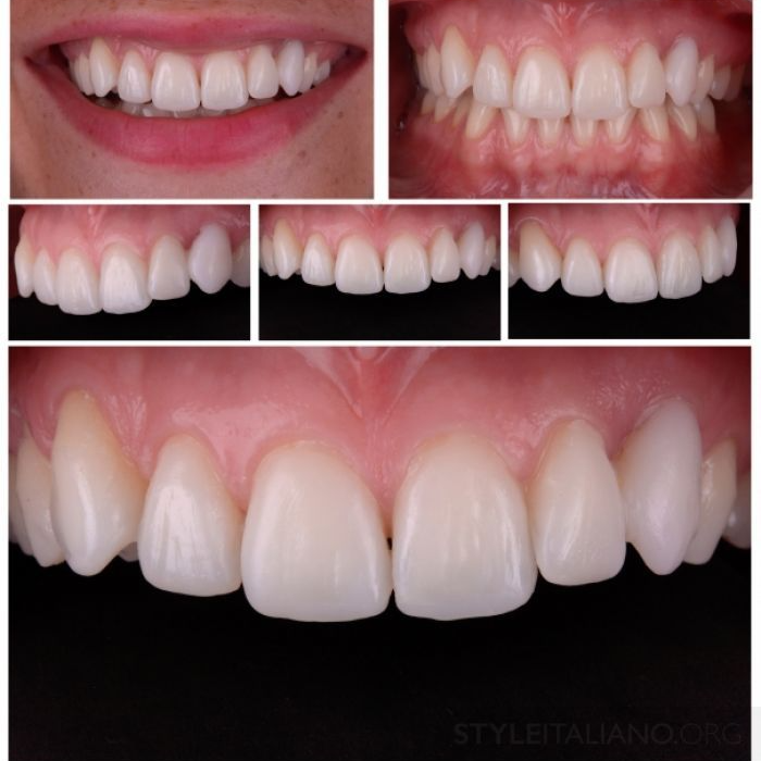 Làm răng sứ như thế nào để đẹp và đúng ý của bạn?