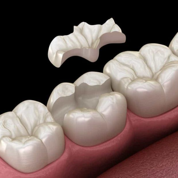 Trám răng như thế nào để có độ bền lâu dài mà không nhạy cảm và ê buốt?