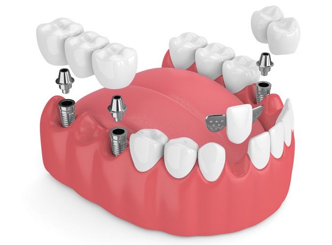 Cầu răng và trụ Implant khác nhau như thế nào?