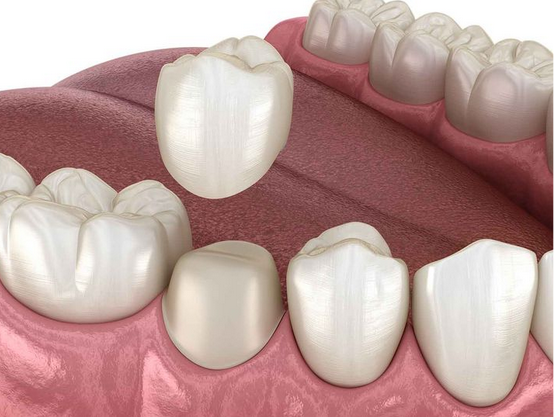 Răng sứ gắn lên đâu để có độ bền được lâu dài và vững chắc?