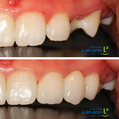 Răng sứ có phải chỉ là chiếc răng giả?