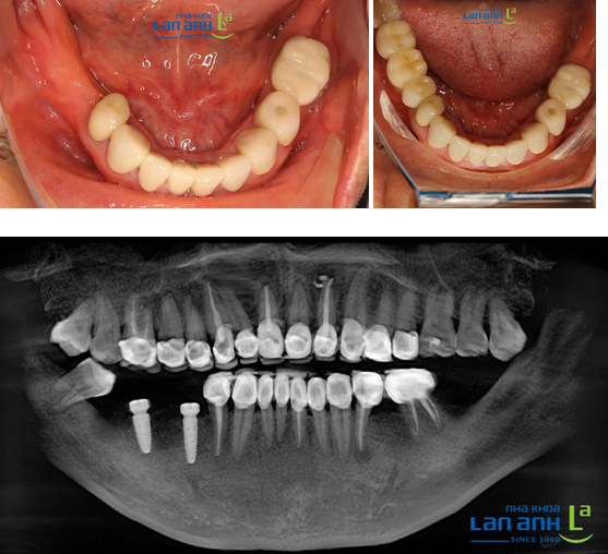 Có nên phục hình cầu răng sứ không?