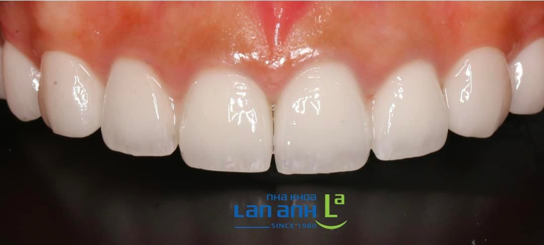 Góc nhìn cận cảnh răng sứ