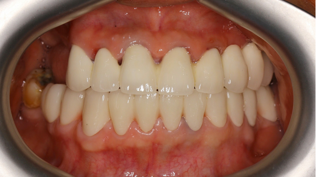 Một trường hợp phục hình răng sứ 2 hàm để ăn nhai và cải thiện thẩm mỹ