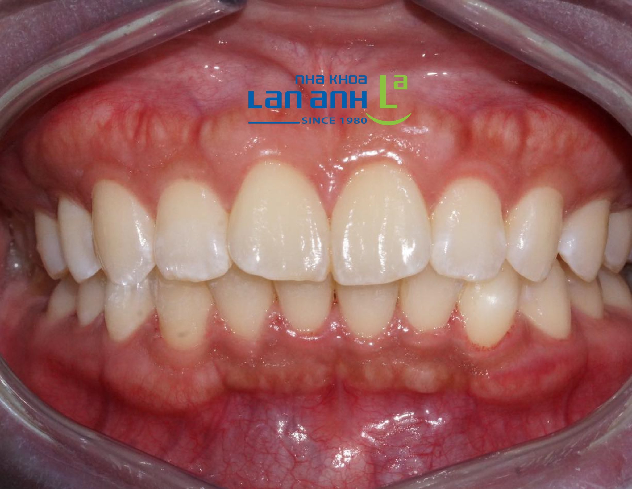 Niềng răng hàm dưới