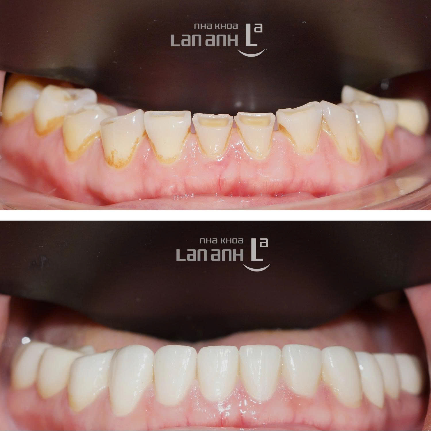 Mòn răng ở tuổi trung niên - có phải do tuổi tác?