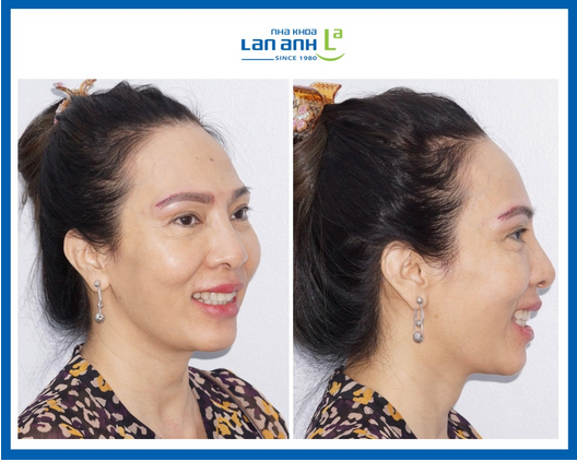 Một trường hợp niềng thành công cho bệnh nhân thế hệ 196x, tại chi nhánh 288/1 Huỳnh Văn Bánh, Phú Nhuận!
