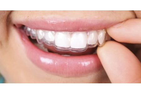 Giá niềng răng Invisalign bao nhiêu?
