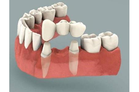 Bọc răng sứ thẩm mỹ và những điều cần biết