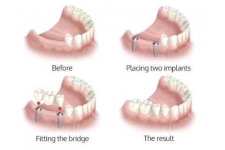 Các phương án trồng răng giả cố định