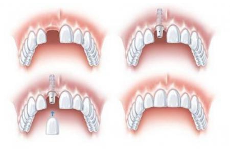 Các phương án trồng răng cửa cố định