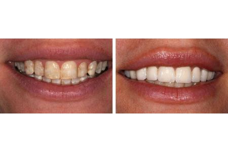 Tôi muốn hỏi giá làm răng sứ Zirconia và giá làm răng sứ Cerec. Với 2 loại răng sứ này thì răng sứ nào tốt hơn?