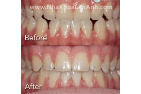 Chỉnh nha phải nhổ nhiều răng, vậy có ảnh hưởng sức khỏe của răng không?