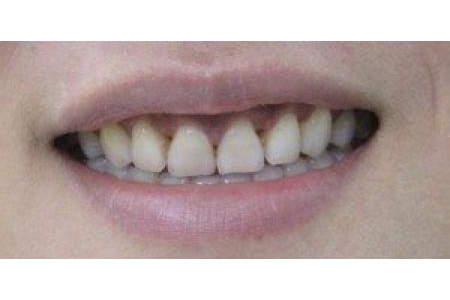 Tôi muốn làm răng sứ thẩm mỹ thì có thể khắc phục cười hở lợi luôn không?