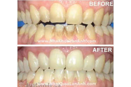Tẩy trắng có thể làm răng tôi trắng sáng trở lại được không?