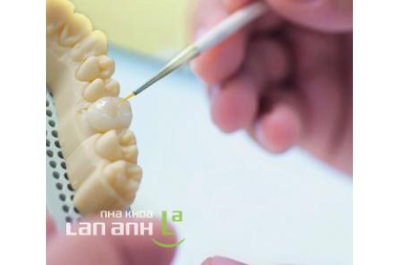 Răng sứ loại nào tốt