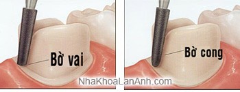 Dieu chinh cui rang veneer