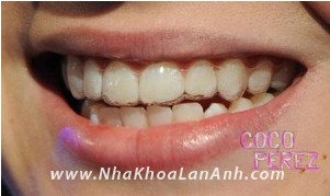 Khay Invisalign dieu tri ham rang duoi