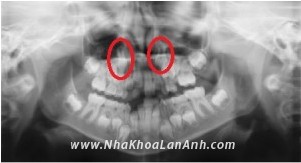 Phim X quang toan canh Panorex