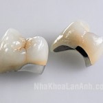 Cau rang su kim loai da hoan tat