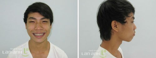 benh nhan ngay sau khi thao mac cai