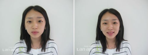 gan mac cai cho benh nhan chinh nha