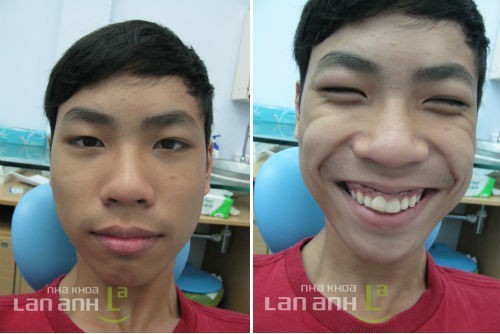 ke hoach chinh nha khong nho rang