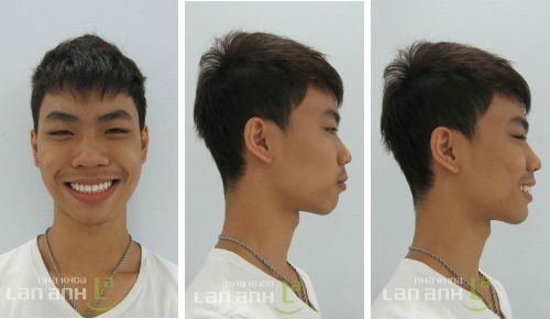 khuon mat voi nu cuoi moi sau khi chinh nha